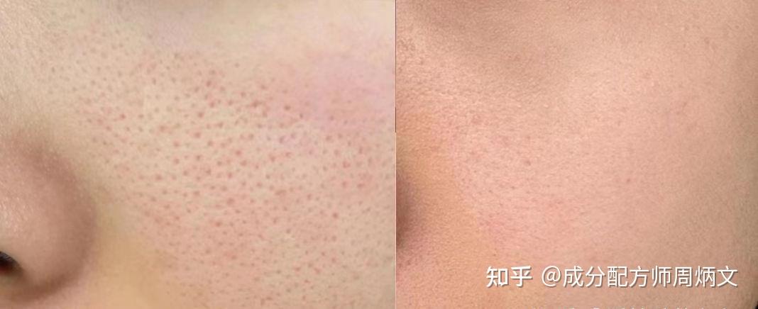 【男生毛孔粗大必看】脸上密密麻麻都是粗大的毛孔,应该如何改善?医学生教你四步轻松解决,将毛孔粗大一网打尽!