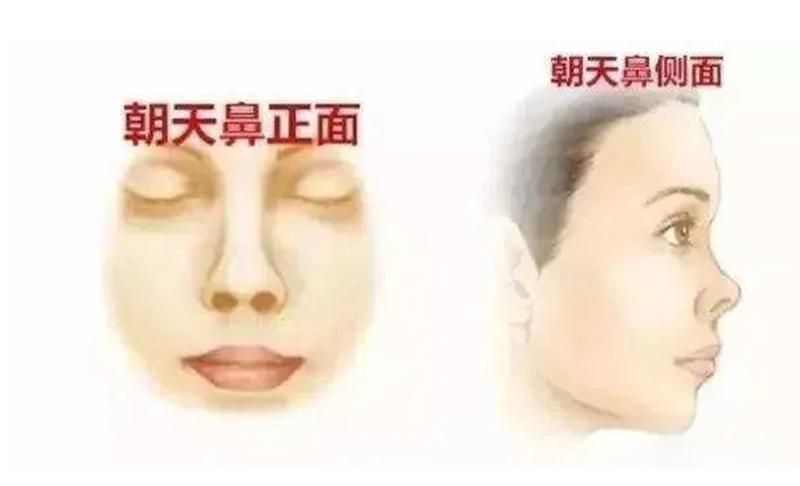 【审美+案例】朝天鼻改善-轻度和重度要分情况来看 - 知乎