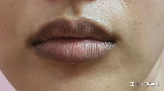 如何解决唇周暗沉情况