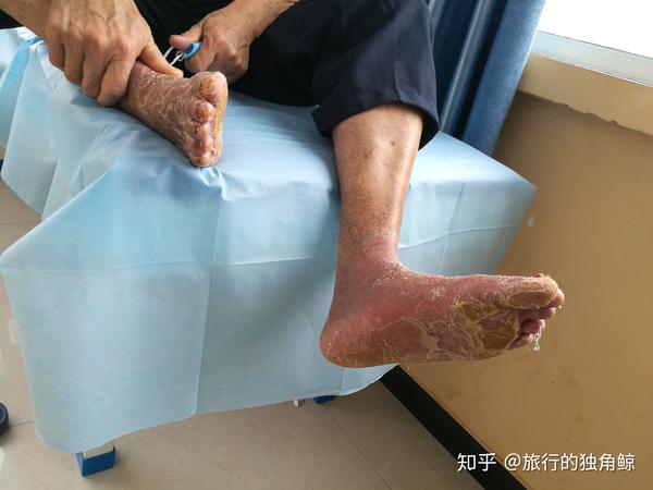 糖尿病患者脚部脱皮是不是糖尿病足早期症状 糖尿病引起的脚脱皮怎么治疗 日部网
