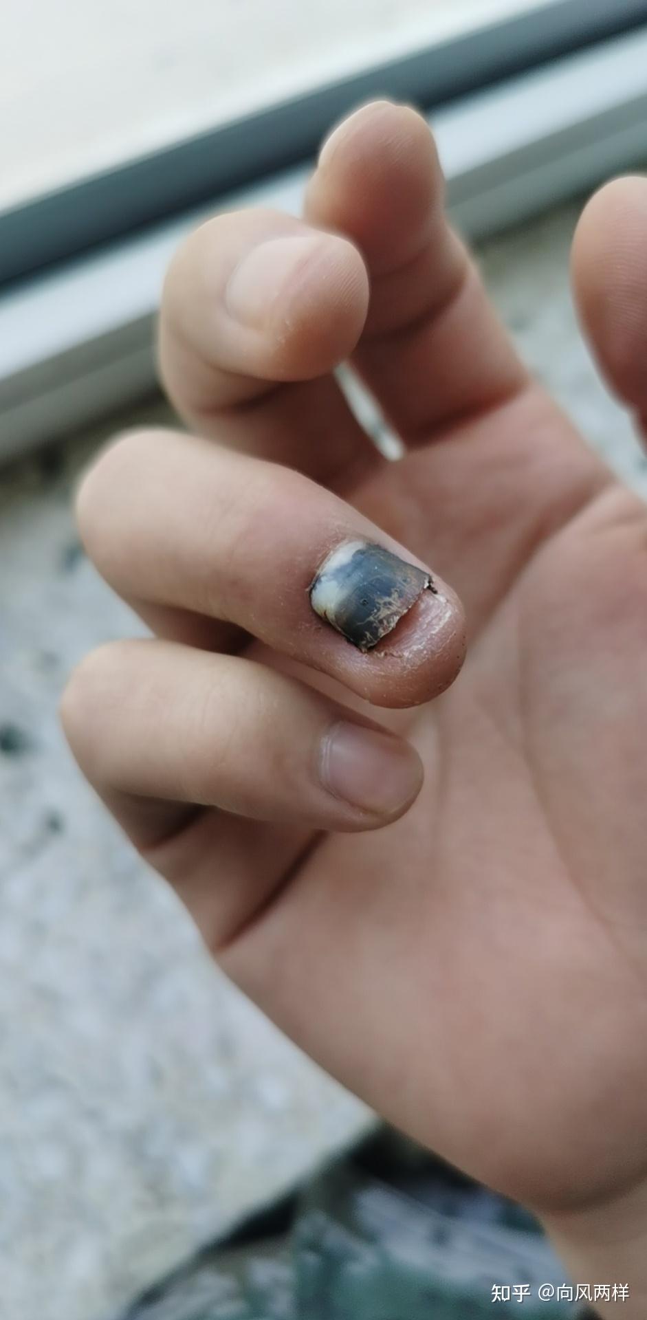 分享手指被砸伤骨折指甲瘀血的经历