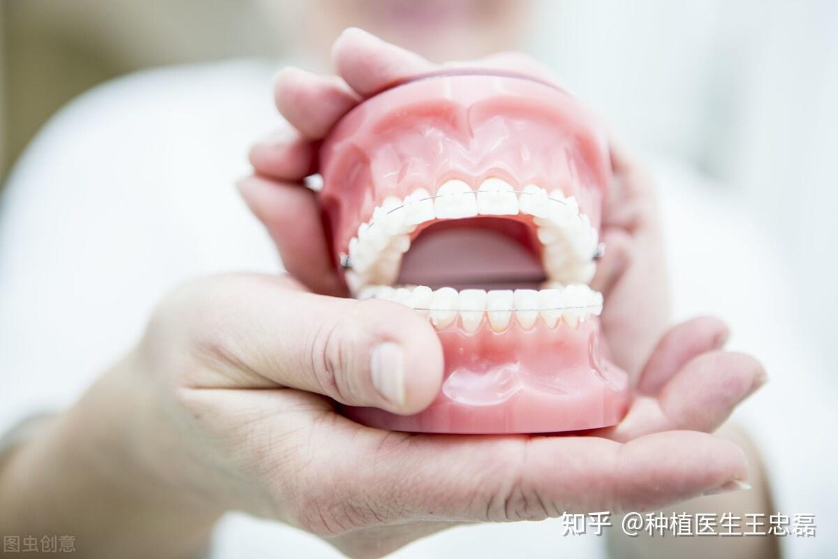如果要做假牙，究竟該做那一種？ – 祐德牙醫診所