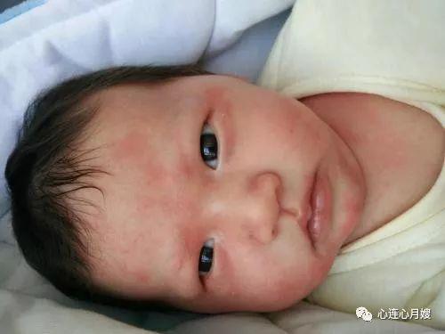 宝宝过敏真难受 皮肤过敏 食物过敏 药物过敏 一篇文章来了解 知乎