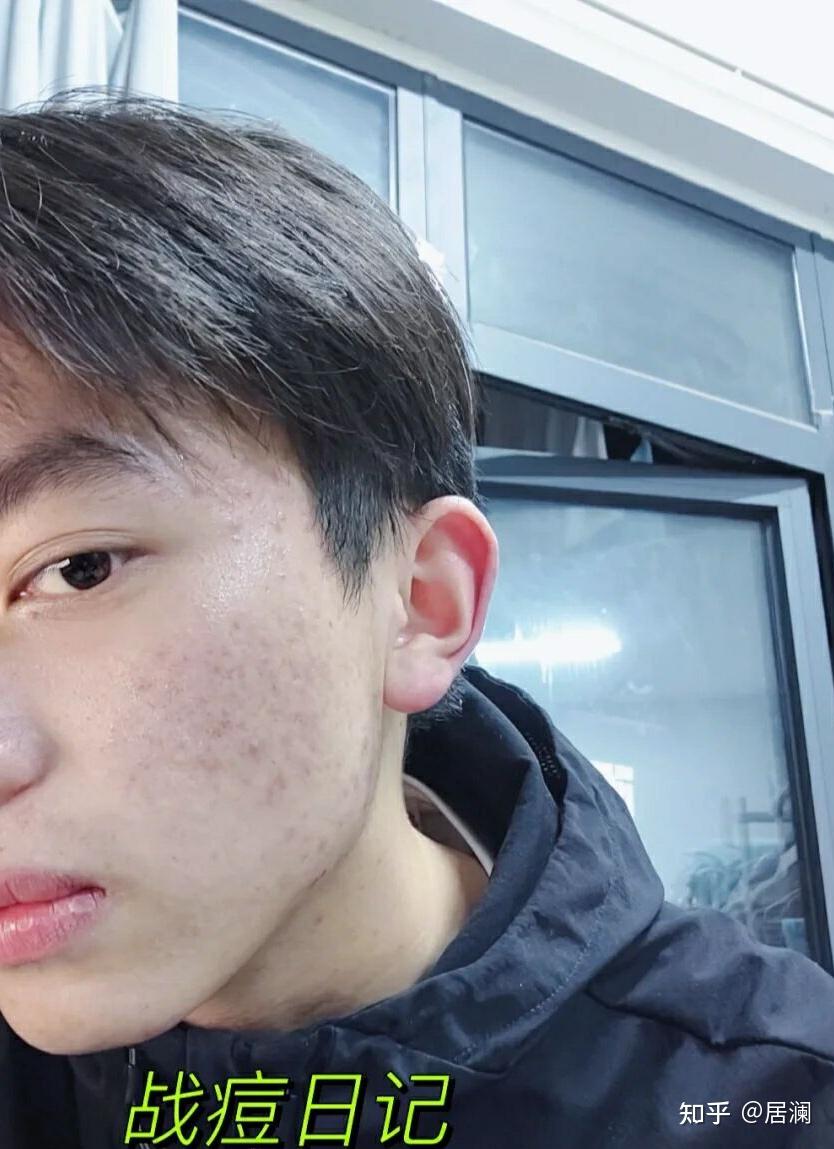 那时我才初中,连青春期都没到,脸上就长满了痘痘18 年第一次去医院