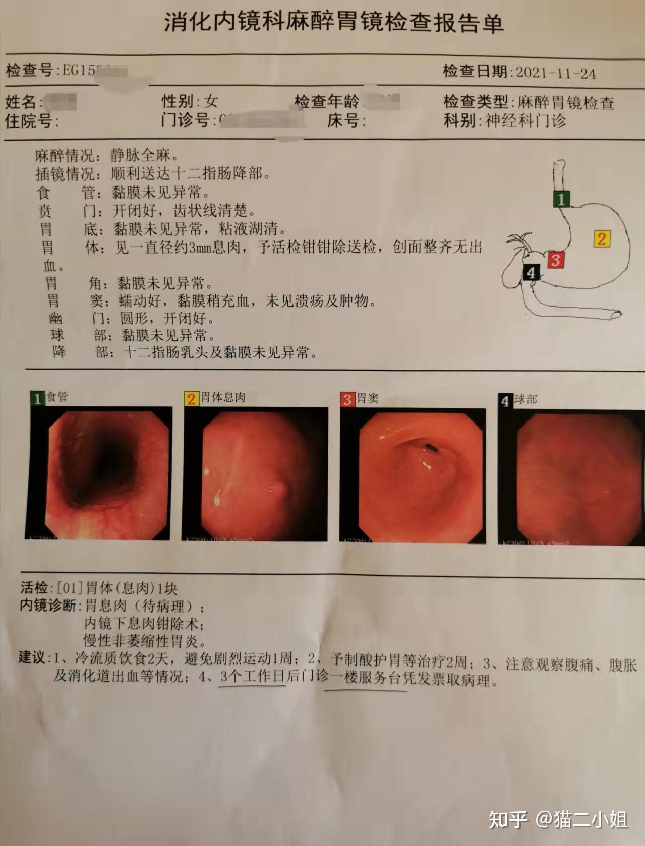 亲历广州中山六院肠胃镜检查,获提胃息肉一块