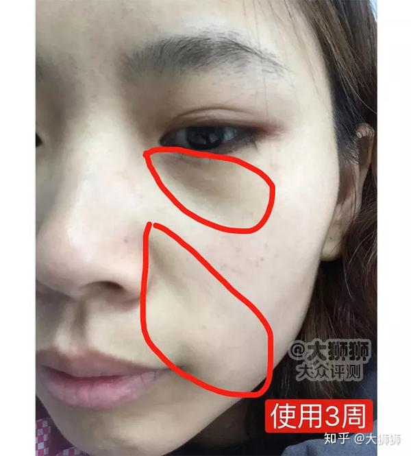 它让少女秒变 大妈 明星也逃不过的 法令纹 怎么去除 知乎