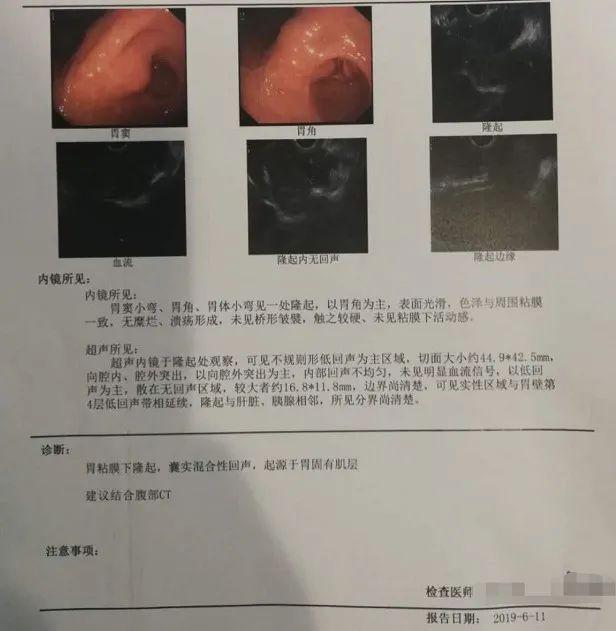 第一次做胃鏡就發現腫瘤剛開始卻沒人知道是什麼