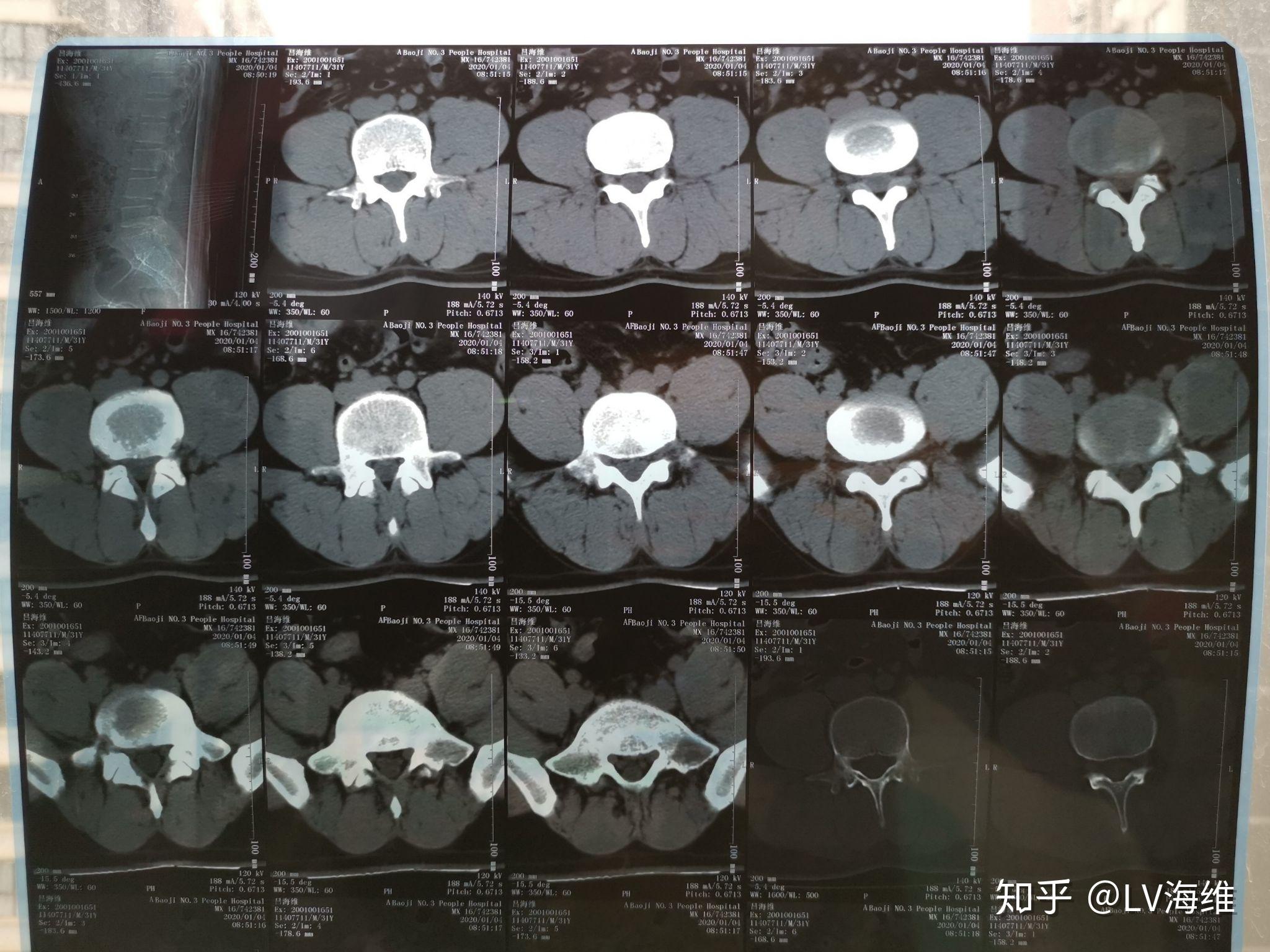 l4 5 l5s1椎间盘的图片图片