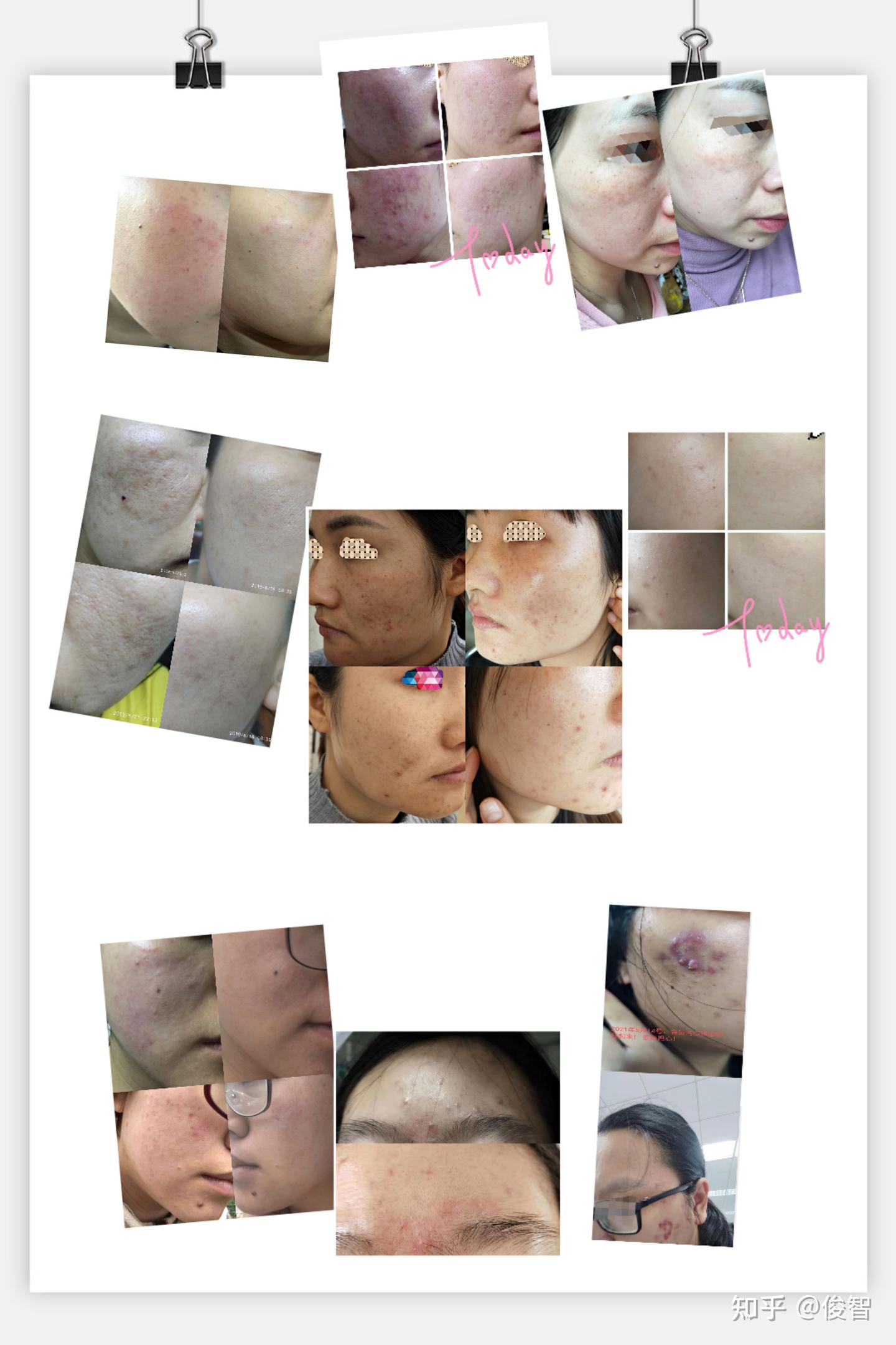 敏感皮肤烂脸修复方法