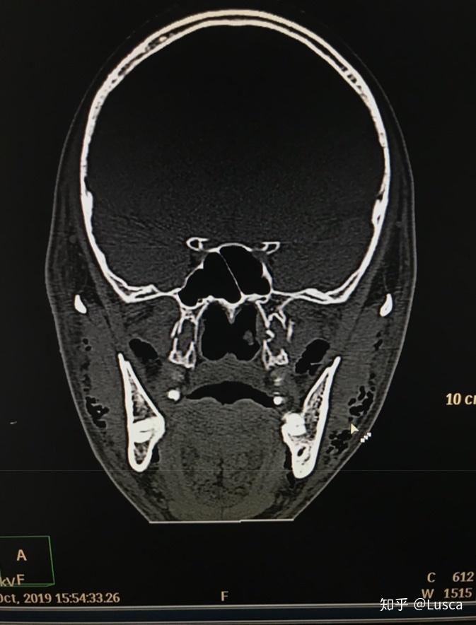 严重的颅面部骨折lefort骨折
