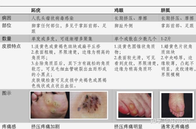 跖疣和鸡眼有什么不同图片