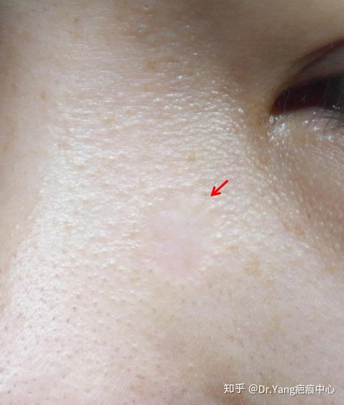 鼻背旁色脱疤痕修复术后