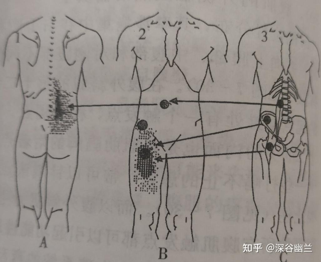 读书笔记髂腰肌触发点