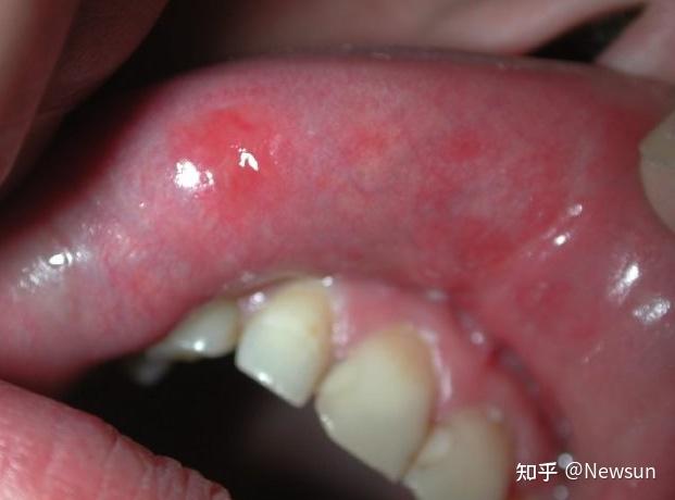 梅毒的九大口腔症状? - 知乎