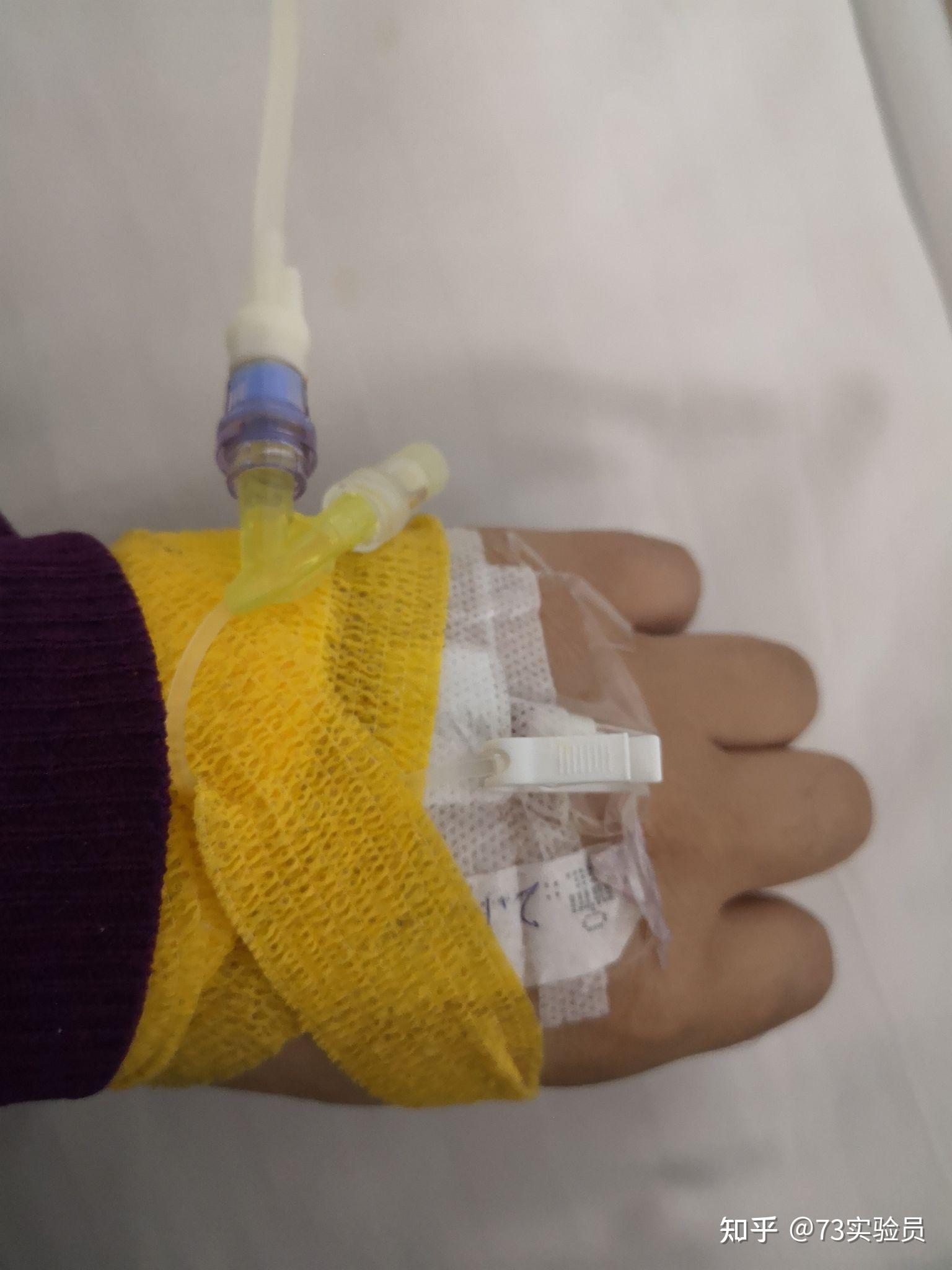 开工前得了阑尾炎是什么体验