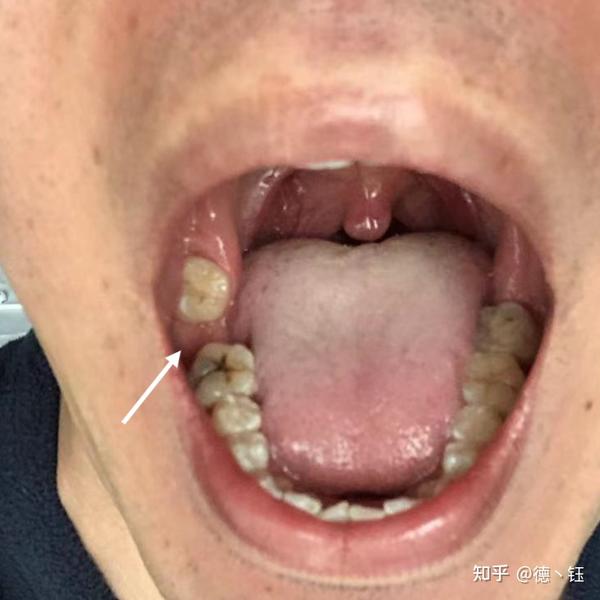 拔烂牙根是一种什么样的体验