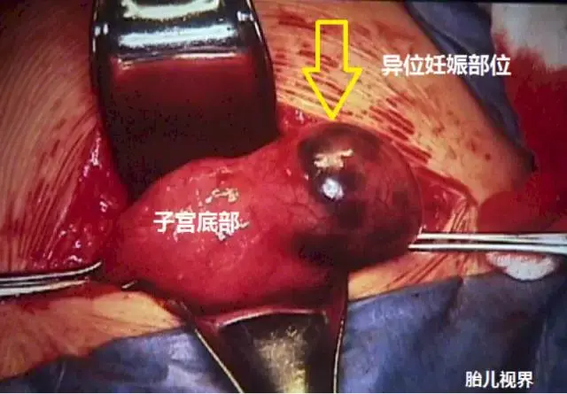 何谓宫外孕宫外孕的胎儿能顺利生长吗能要吗兼谈宫外孕的超声显像特点