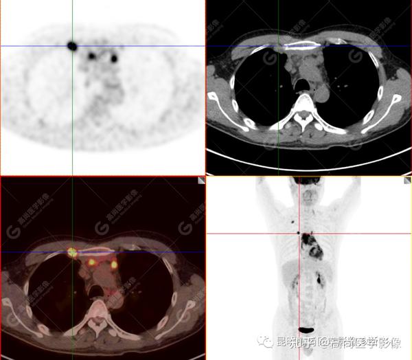 PET/CT诊断胸腺癌一例【高尚医学影像】 - 知乎