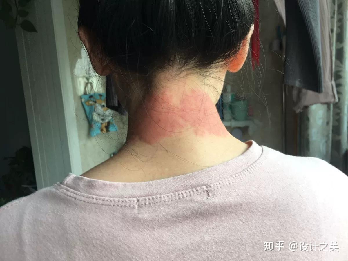 skg商品标注隐瞒电极片过敏和诱发淋巴结肿大