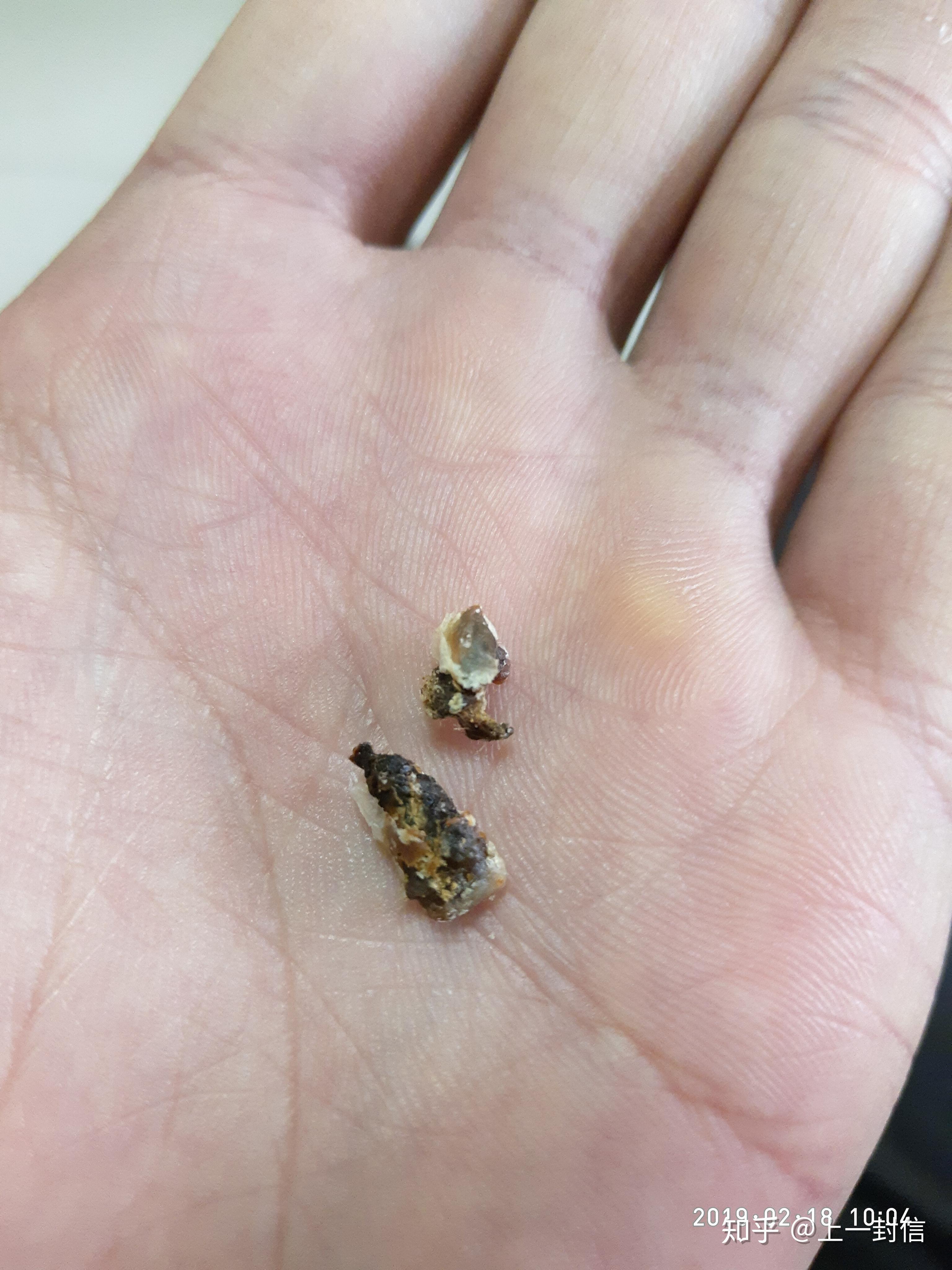 耳屎最大能有多大