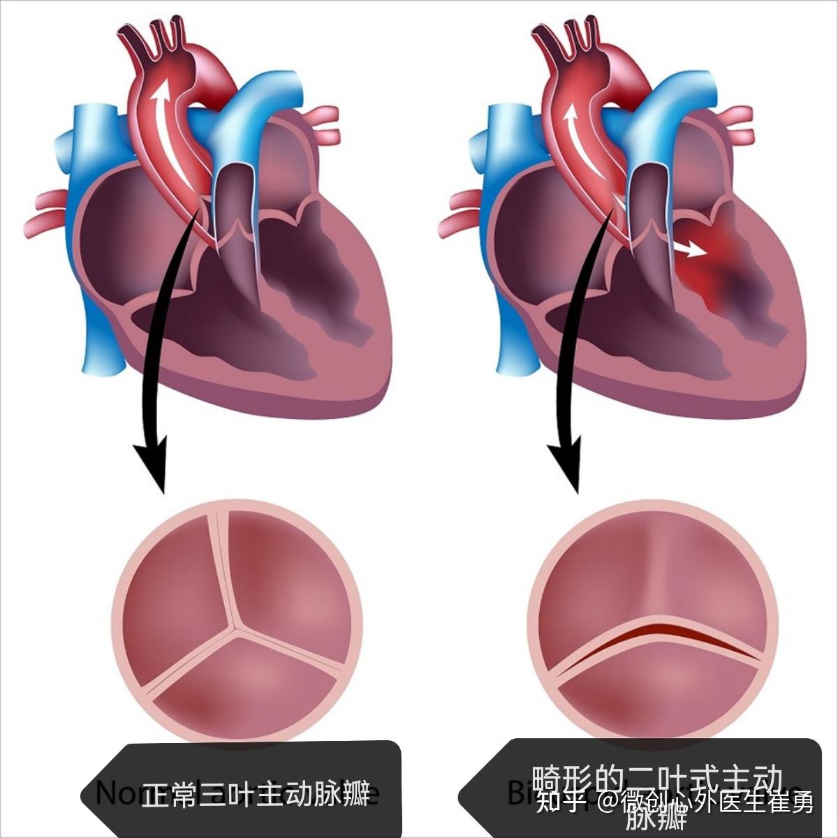 不开胸的换瓣手术—为主动脉瓣狭窄患者开启幸福之门-科室动态-清华大学附属北京清华长庚医院心脏内科