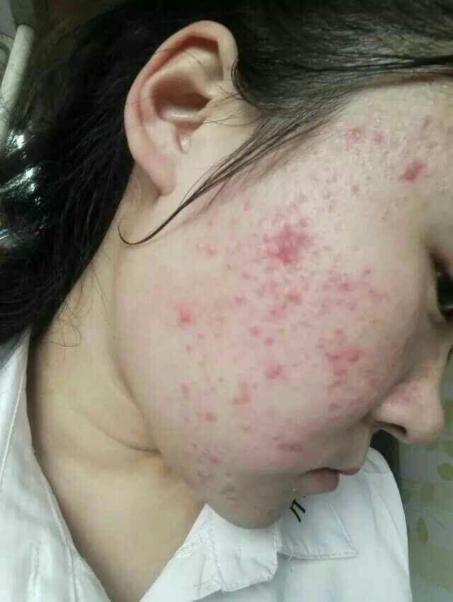 满脸痘痘很自卑,怎么办? - 知乎