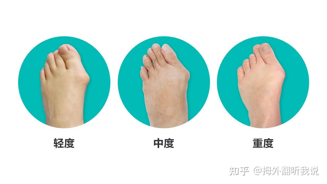 张树伟科普：正确认识拇外翻 - 知乎