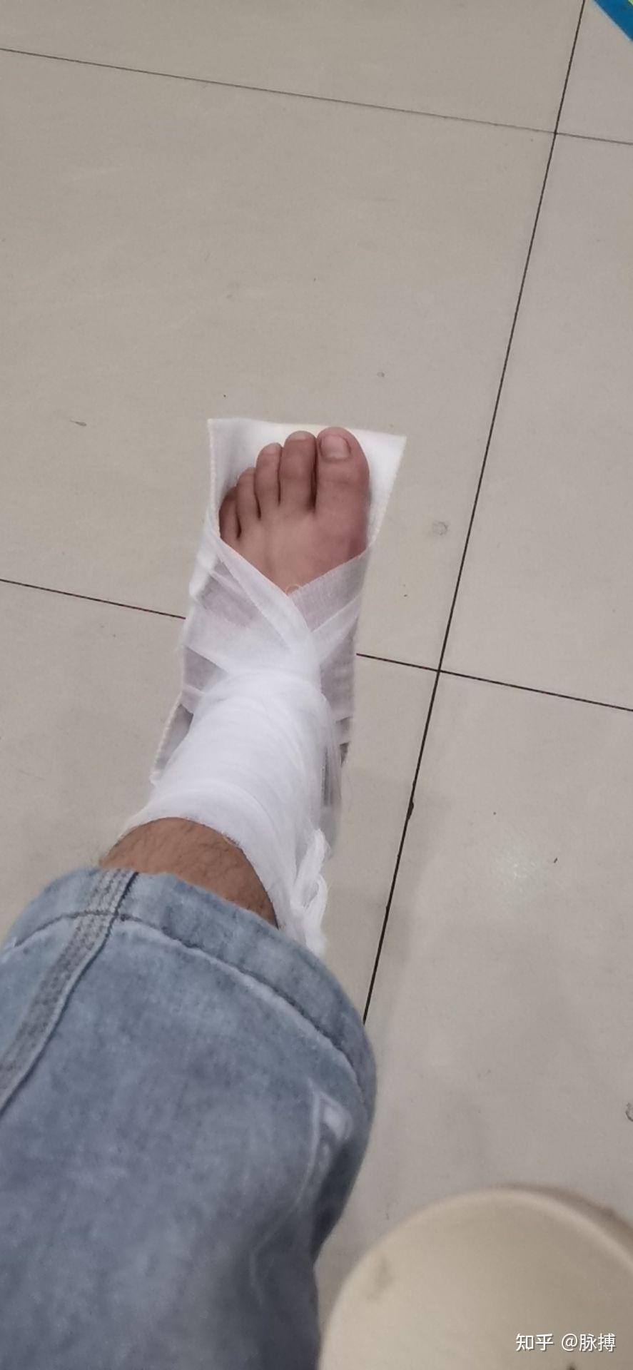 痛的要命,脚趾头几乎不能动弹,然后18点去中心医院拍片,八点打上石膏
