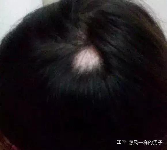 斑秃怎么办