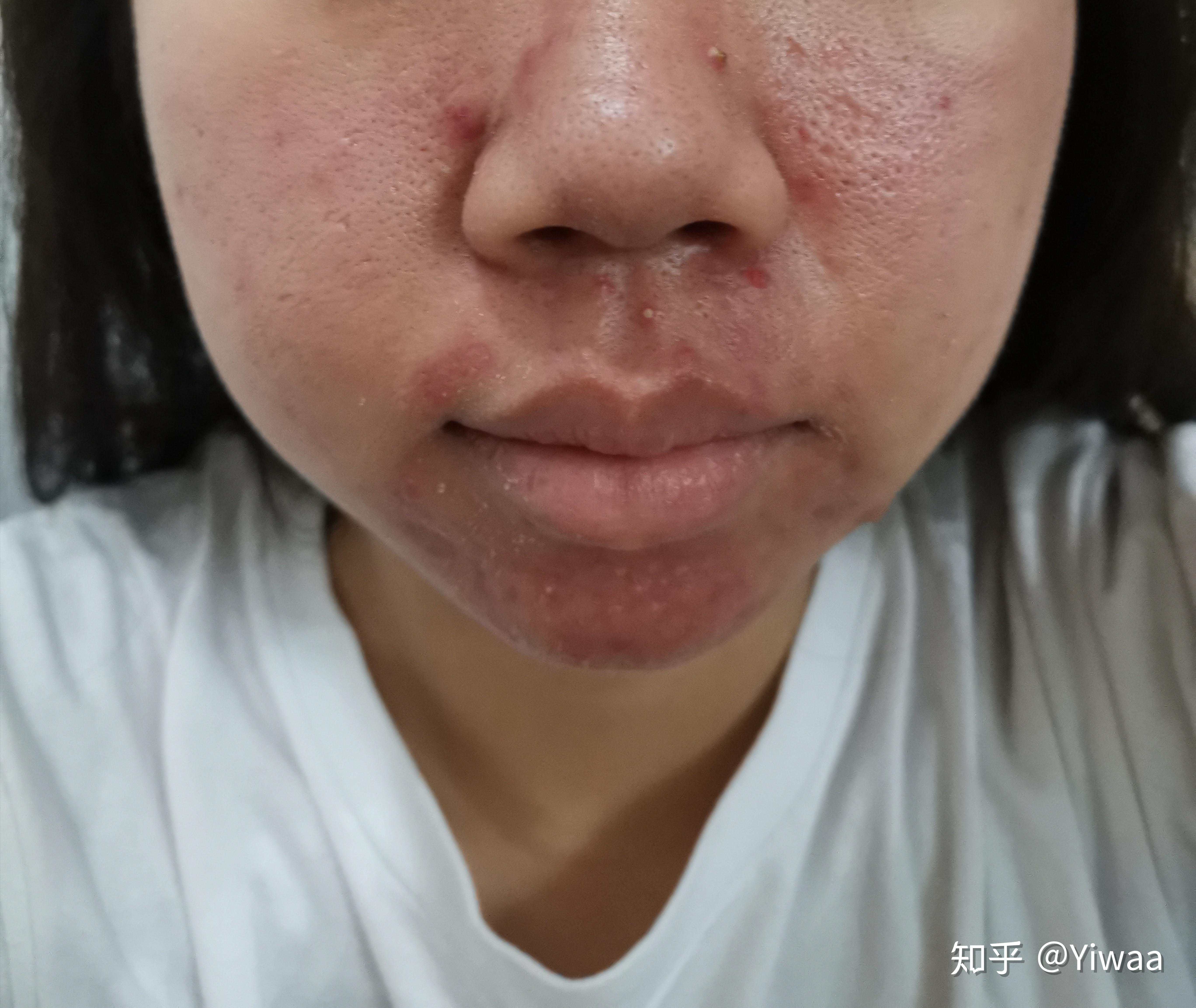 记录服用泰尔丝异维a酸软胶囊