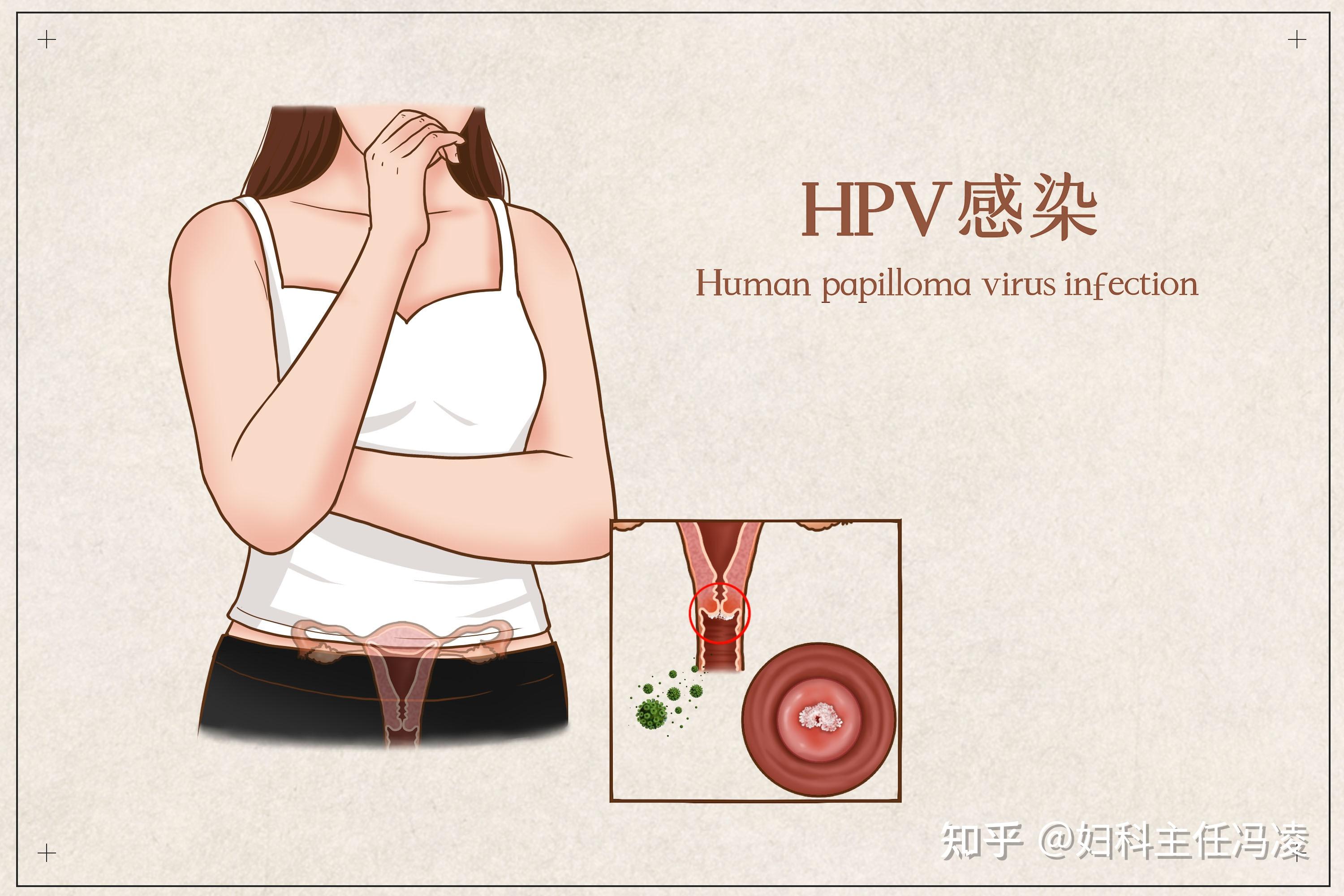 hpv感染女性全身图片