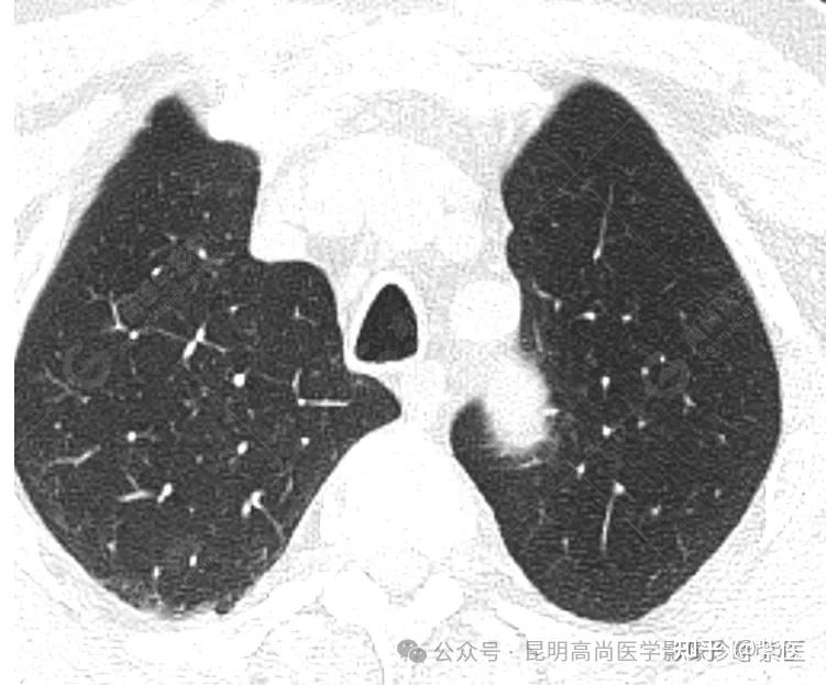 老人痰中带血,PET/CT诊断肺乳头状鳞状细胞癌 - 知乎