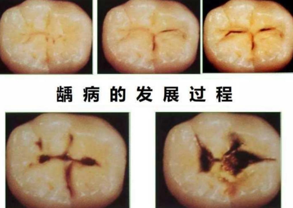 蛀牙从小洞不补到大洞吃苦,总共分几步? 