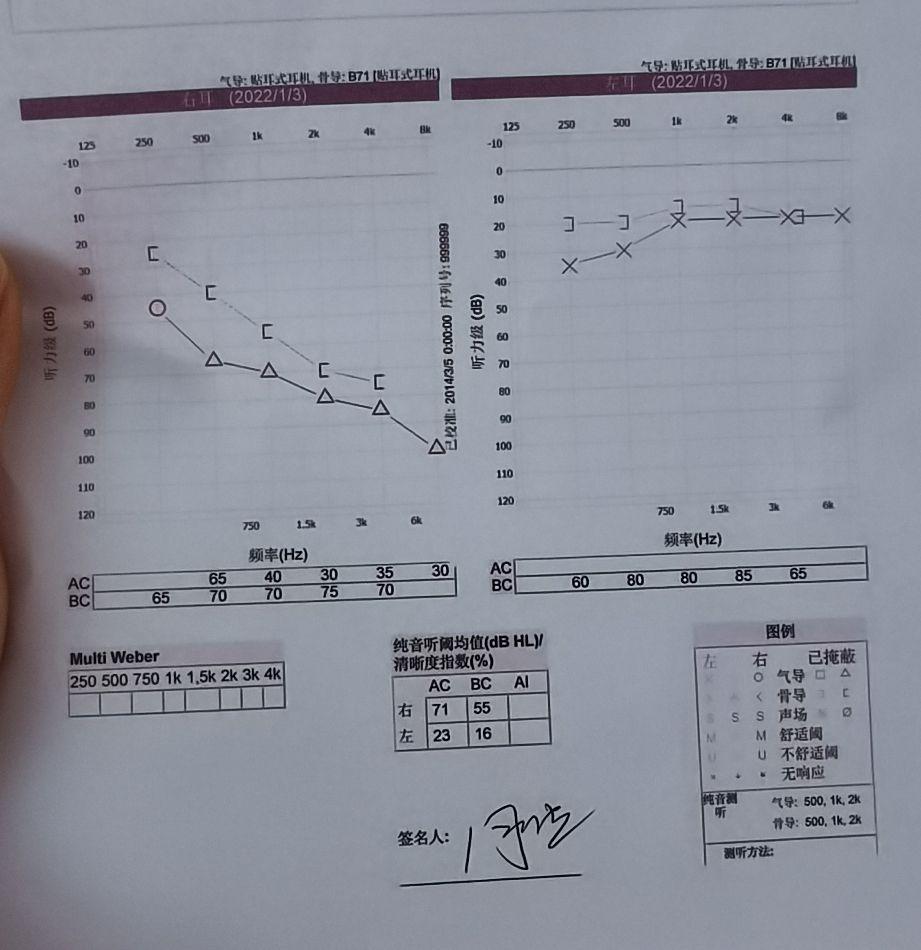 耳硬化症纯音测听图图片