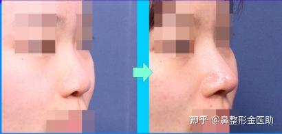 鞍鼻做完隆鼻手术后有哪些禁忌? - 知乎