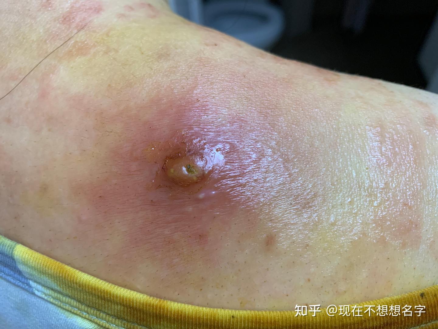自己处理两次不同的火疖子 - 知乎