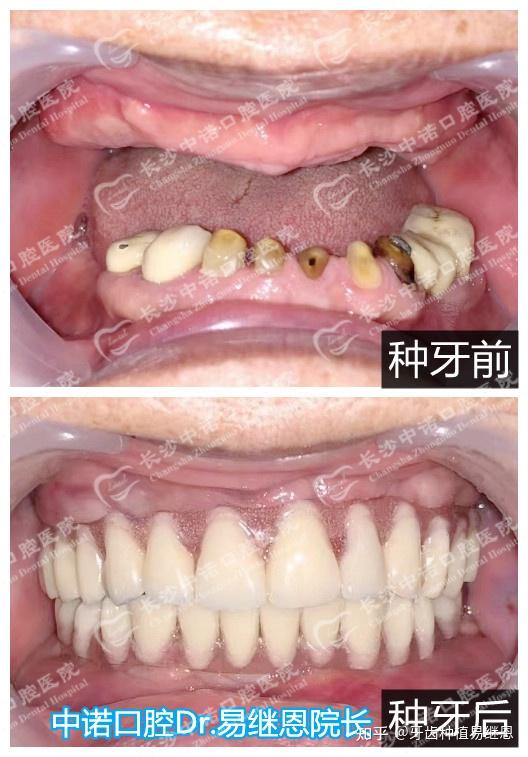 案例三:患者上半口牙齒缺失較多,下半口牙齦萎縮,牙齒搖搖欲墜,已失去