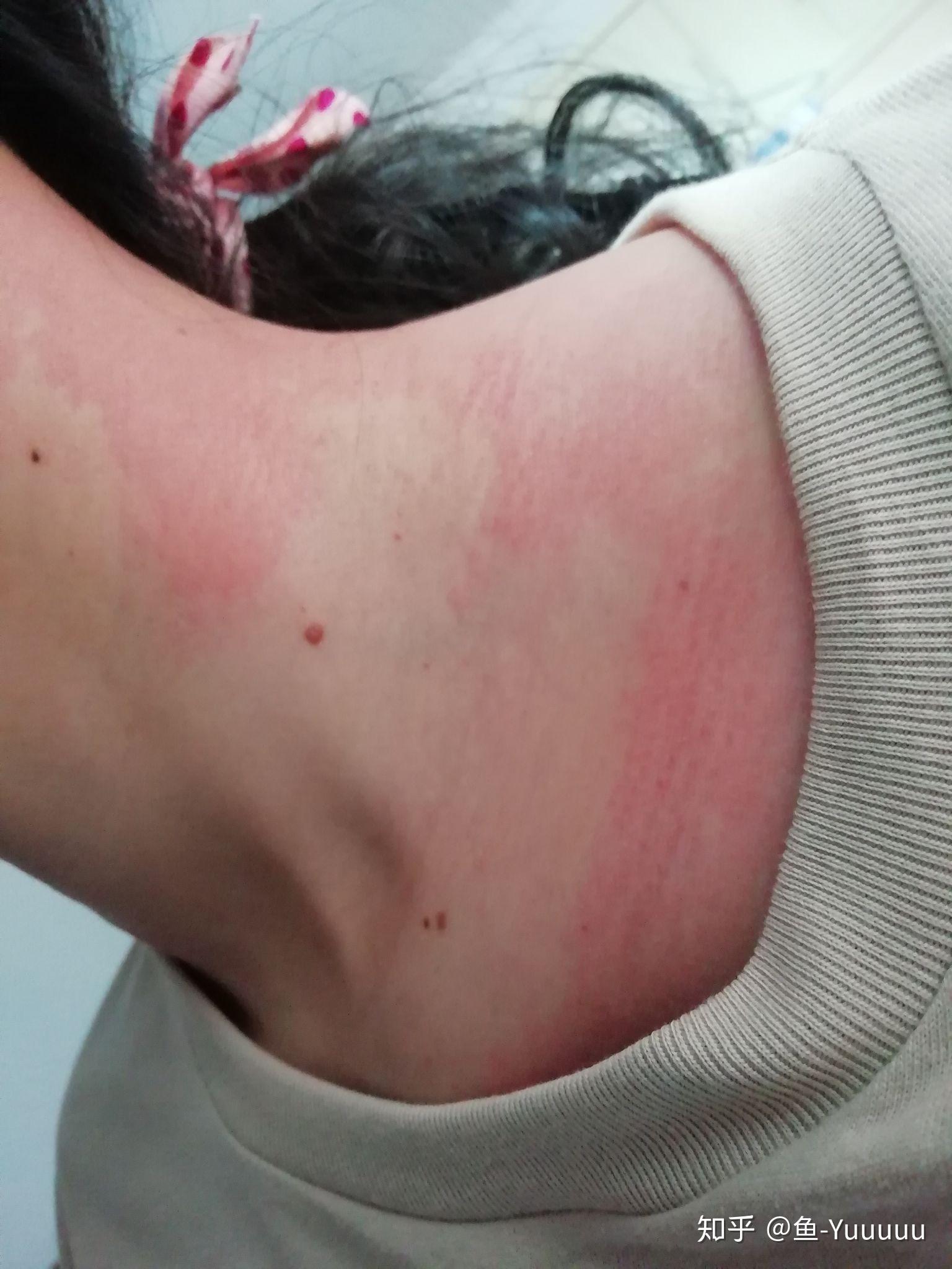 给不确定是不是过敏的参考当天晚上是最难受的,睡着被痒醒了,然后连