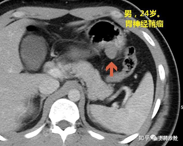 如何用CT区分:胃间质瘤和胃神经鞘瘤 - 知乎