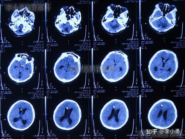 腦出血後腦積水4月內3家醫院治後病情仍反覆頭頸肩