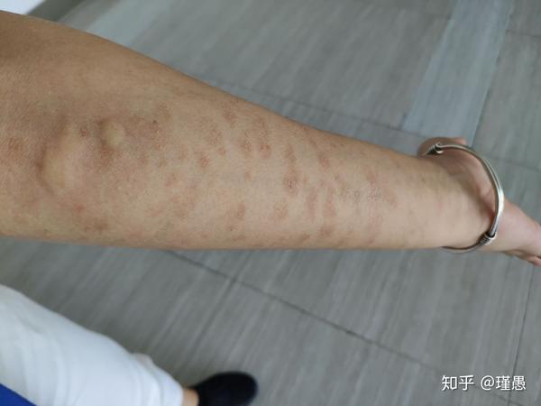 玫瑰糠疹的艰难史诗