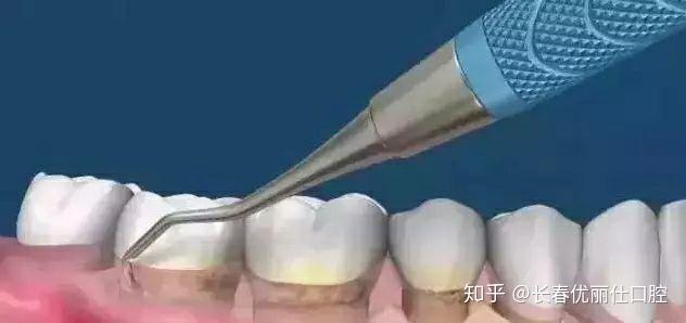【科普】史上最详细的洗牙过程图解 知乎 
