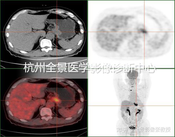 PET/MR在胃癌伴肝转移的案例分享 - 知乎