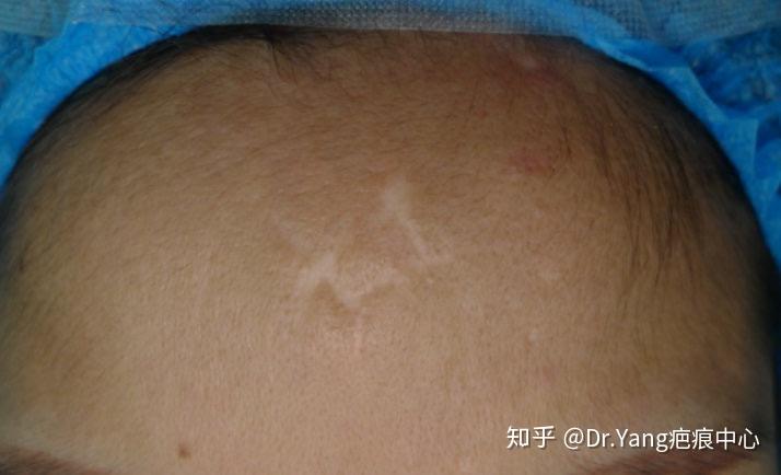 一例色脱疤痕术后半个月
