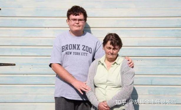 巨人症不仅仅表现为身高异常,还表现为四肢末端粗大等一系列异常.