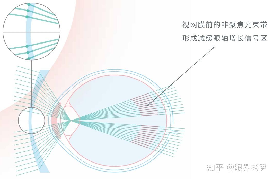 星趣控控制近视原理2,星趣控的价格如何?
