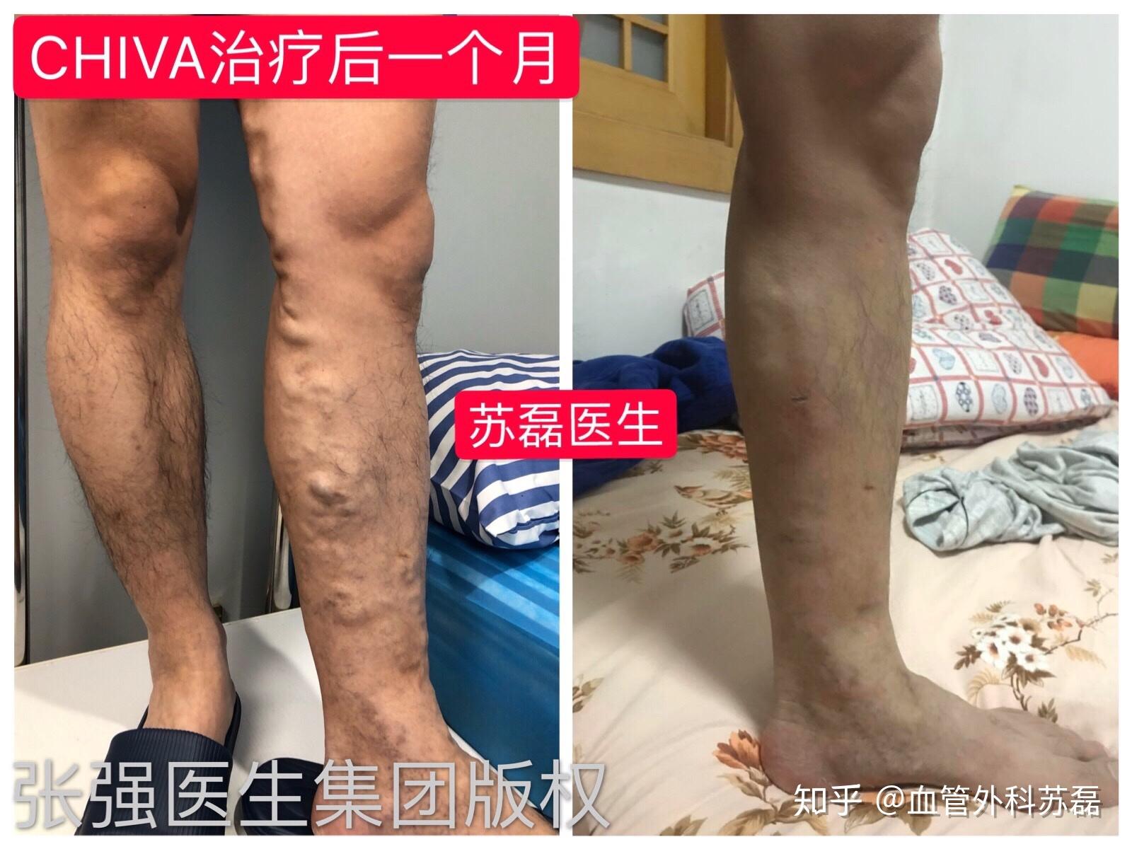 静脉曲张手术治疗效果图
