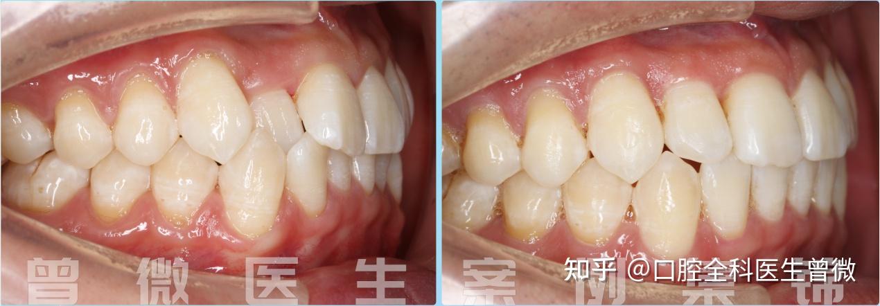 患者情况:智齿挤压牙列,致使正常牙齿被挤出牙列轨道,造成一侧的侧