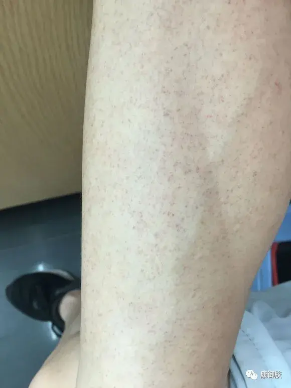 腋下鸡皮疙瘩黑色素沉淀(腋下皮肤黑色素沉淀是什么原因引起的)