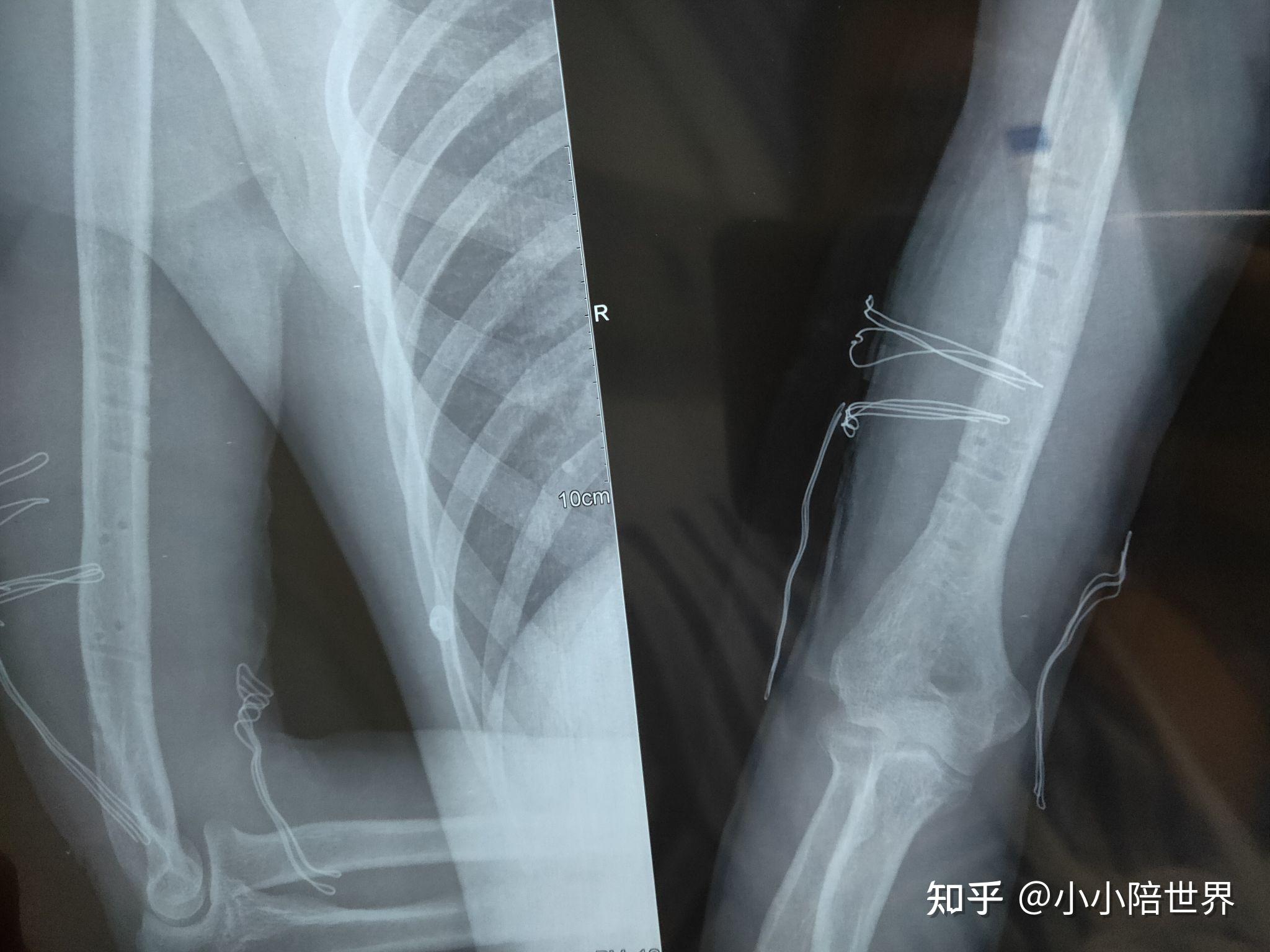 右肱骨骨折钢板取出风险有多大?可以取出吗? - 知乎